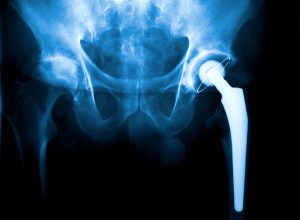 X-ray of a Arthroplasty of the hip joint
